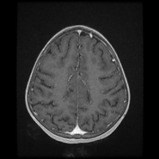 File:Cerebral and spinal tuberculosis (Radiopaedia 90489-107837 Axial T1 C+ 143).jpg