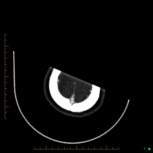 Cerebral arteriovenous malformation (AVM) (Radiopaedia 78162-90706 Axial CTA 247).jpg
