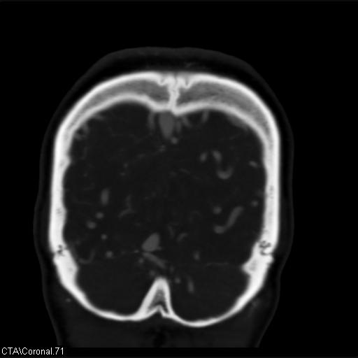Cerebral arteriovenous malformation (Radiopaedia 28518-28759 C 71).jpg