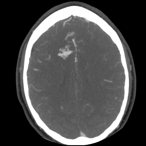 Cerebral arteriovenous malformation (Radiopaedia 39259-41505 AX CEREBRAL CTA 37).png
