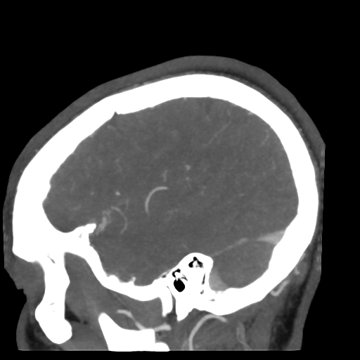 Cerebral arteriovenous malformation (Radiopaedia 39259-41505 Sagittal 49).png