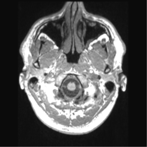 Cerebral arteriovenous malformation (Radiopaedia 39259-41506 Axial T1 8).png
