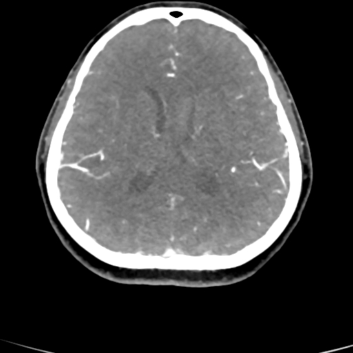 Cerebral arteriovenous malformation (Radiopaedia 73830-84645 B 43).jpg