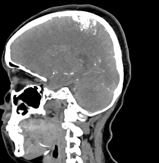 Cerebral arteriovenous malformation (Radiopaedia 73830-84645 D 58).jpg