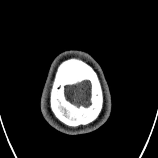 Cerebral arteriovenous malformation (Radiopaedia 78188-90746 Axial non-contrast 174).jpg