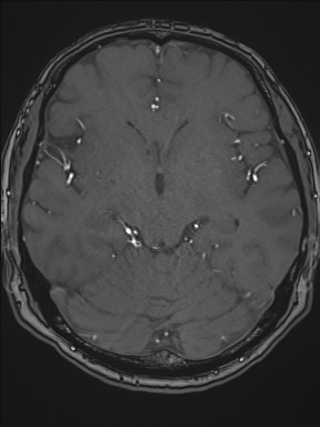 Cerebral arteriovenous malformation (Radiopaedia 84015-99245 Axial TOF 112).jpg