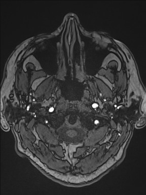 Cerebral arteriovenous malformation (Radiopaedia 84015-99245 Axial TOF 30).jpg