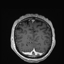 Cerebral arteriovenous malformation (Radiopaedia 84015-99245 Coronal T1 C+ 136).jpg