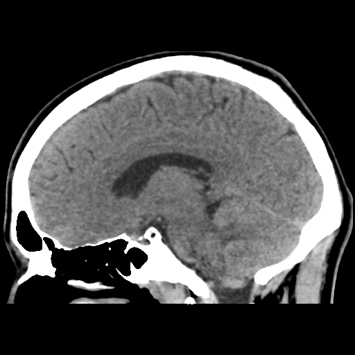 Cerebral arteriovenous malformation (Spetzler-Martin grade 2) (Radiopaedia 41262-44076 A 35).png
