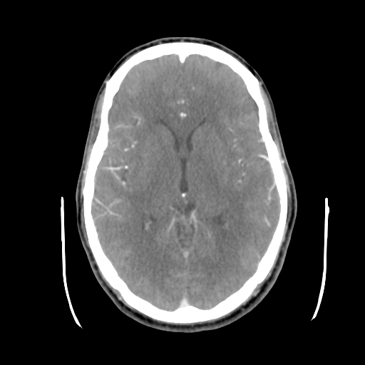 Cerebral arteriovenous malformation (Spetzler-Martin grade 2) (Radiopaedia 41262-44076 Axial C+ 25).png