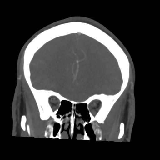 Cerebral arteriovenous malformation (Spetzler-Martin grade 2) (Radiopaedia 41262-44076 F 17).png
