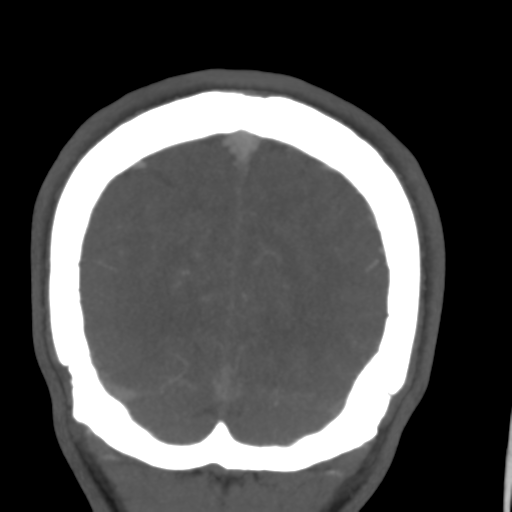 Cerebral arteriovenous malformation (Spetzler-Martin grade 2) (Radiopaedia 41262-44076 F 56).png