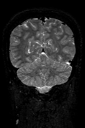 Cerebral arteriovenous malformation at posterior body of corpus callosum (Radiopaedia 74111-84925 Coronal T2 137).jpg