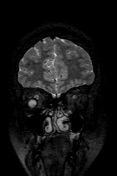 Cerebral arteriovenous malformation at posterior body of corpus callosum (Radiopaedia 74111-84925 Coronal T2 28).jpg