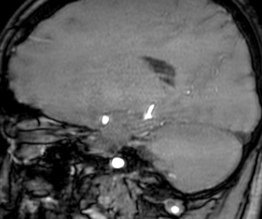 Cerebral arteriovenous malformation at posterior body of corpus callosum (Radiopaedia 74111-84925 J 250).jpg