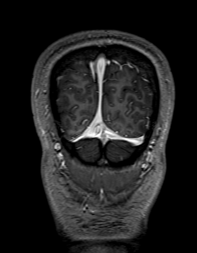 Cerebral arteriovenous malformation at posterior body of corpus callosum (Radiopaedia 74111-84925 K 343).jpg