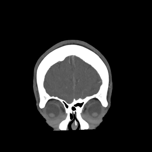 Cerebral arteriovenous malformation with lobar hemorrhage (Radiopaedia 35598-57216 C 12).jpg