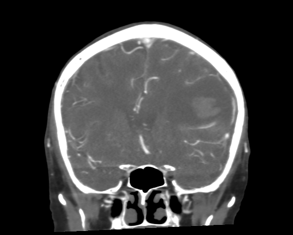 Cerebral arteriovenous malformation with lobar hemorrhage (Radiopaedia 44725-48511 A 22).png