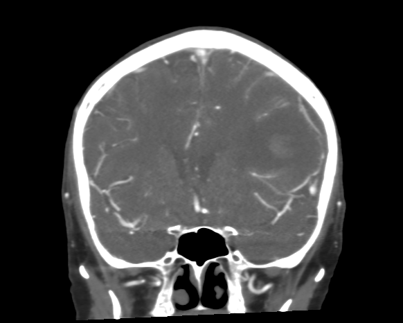 Cerebral arteriovenous malformation with lobar hemorrhage (Radiopaedia 44725-48511 A 23).png