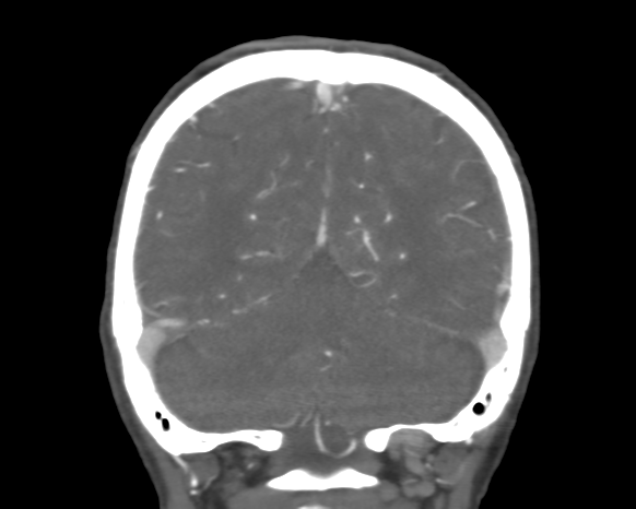 File:Cerebral arteriovenous malformation with lobar hemorrhage (Radiopaedia 44725-48511 A 44).png