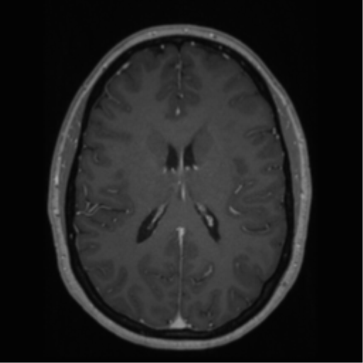 Cerebral cavernoma and development venous anomaly (Radiopaedia 37603-39482 Axial T1 C+ 45).png