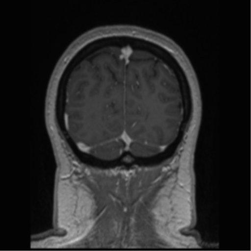 Cerebral cavernoma and development venous anomaly (Radiopaedia 37603-39482 Coronal T1 C+ 16).png