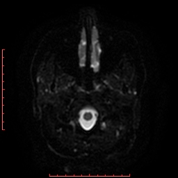 File:Cerebral cavernous malformation (Radiopaedia 26177-26306 Axial DWI 23).jpg