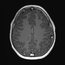 Cerebral cavernous venous malformation (Radiopaedia 70008-80021 Axial T1 C+ 60).jpg
