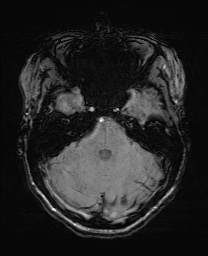 File:Cerebral cavernous venous malformation (Radiopaedia 70008-80021 I 19).jpg