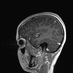 Cerebral cavernous venous malformation (Radiopaedia 70008-80021 Sagittal T1 C+ 56).jpg