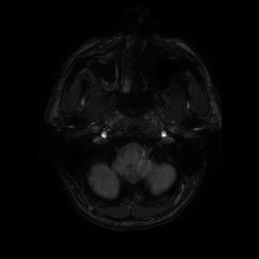 Cerebral cavernous venous malformation (Zabramski type II) (Radiopaedia 85511-101198 Axial SWI 15).jpg