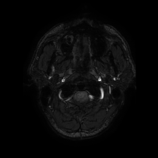 Cerebral cavernous venous malformation (Zabramski type II) (Radiopaedia 85511-101198 Axial SWI 5).jpg
