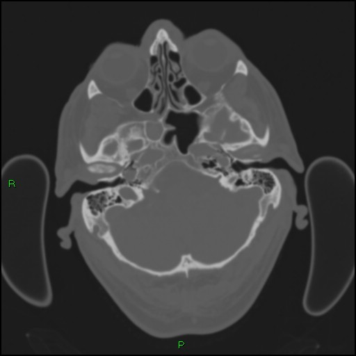 Cerebral contusions (Radiopaedia 33868-35039 Axial bone window 34).jpg