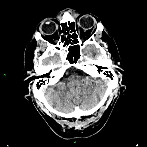 File:Cerebral contusions (Radiopaedia 33868-35039 Axial non-contrast 40).jpg