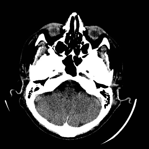Cerebral edema (evolution in time) (Radiopaedia 19418-19440 non-contrast 25).jpg
