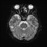 Cerebral embolic infarcts (embolic shower) (Radiopaedia 72391-82921 Axial DWI 9).jpg