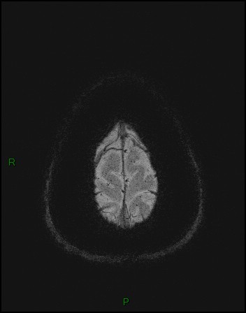Cerebral fat embolism (Radiopaedia 35022-36525 Axial SWI 64).jpg