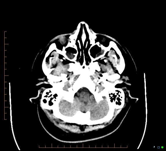 Cerebral fat embolism (Radiopaedia 85521-101220 Axial non-contrast 15).jpg