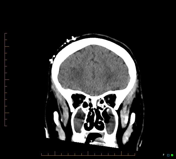 Cerebral fat embolism (Radiopaedia 85521-101220 Coronal non-contrast 18).jpg