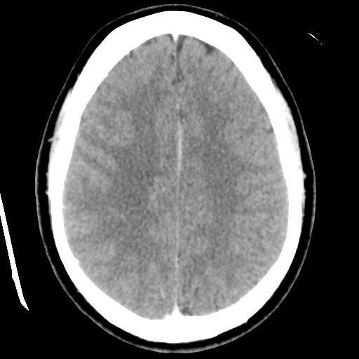 File:Cerebral hemorrhage secondary to arteriovenous malformation (Radiopaedia 33497-34561 B 38).png