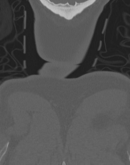Cerebral hemorrhagic contusions and cervical spine fractures (Radiopaedia 32865-33841 Coronal bone window 87).jpg