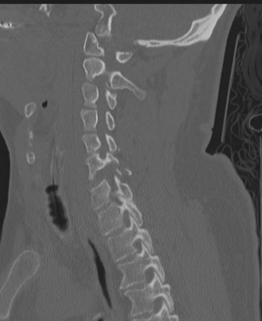 Cerebral hemorrhagic contusions and cervical spine fractures (Radiopaedia 32865-33841 Sagittal bone window 44).jpg