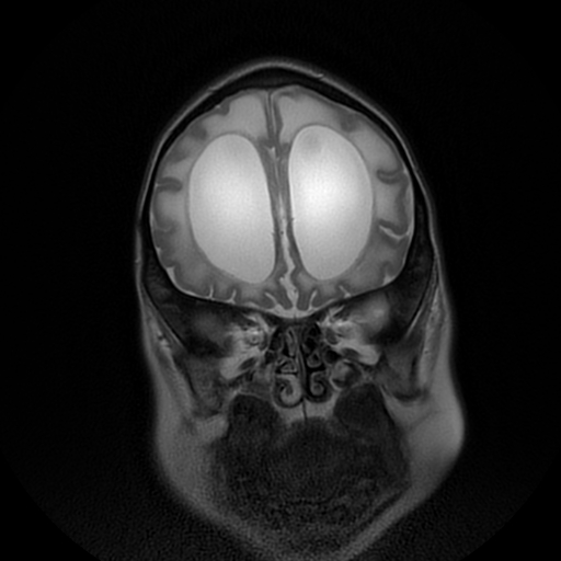 File:Cerebral manifestations of mucopolysaccharidosis type I (Radiopaedia 59171-66487 Coronal T2 4).jpg