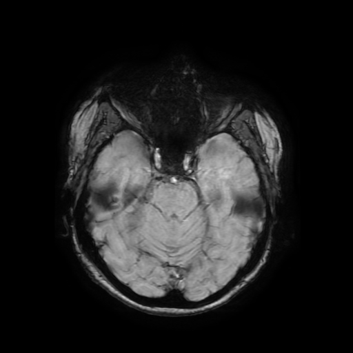 Cerebral metastases - melanoma (Radiopaedia 80972-94522 Axial SWI 33).jpg