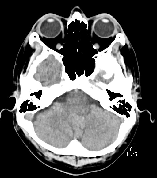 Cerebral metastases - testicular choriocarcinoma (Radiopaedia 84486-99855 Axial non-contrast 43).jpg