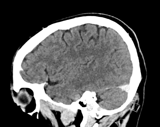Cerebral metastases - testicular choriocarcinoma (Radiopaedia 84486-99855 F 43).jpg