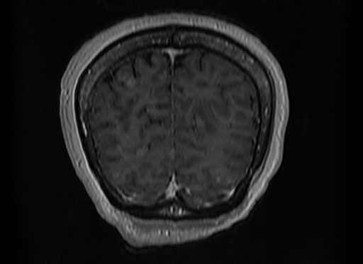 File:Cerebral metastases from lung cancer with amyloid angiopathy and cerebellopontine angle meningioma (Radiopaedia 74306-85191 Coronal T1 C+ 52).jpg