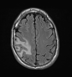 File:Cerebral metastasis - melanoma (Radiopaedia 54718-60954 Axial FLAIR 23).png