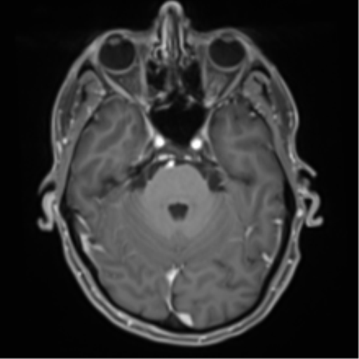 Cerebral metastasis - melanoma (Radiopaedia 54718-60954 Axial T1 C+ fat sat 17).png