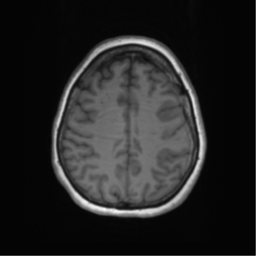 Cerebral metastasis mimicking glioblastoma (Radiopaedia 69155-78937 Axial T1 50).png